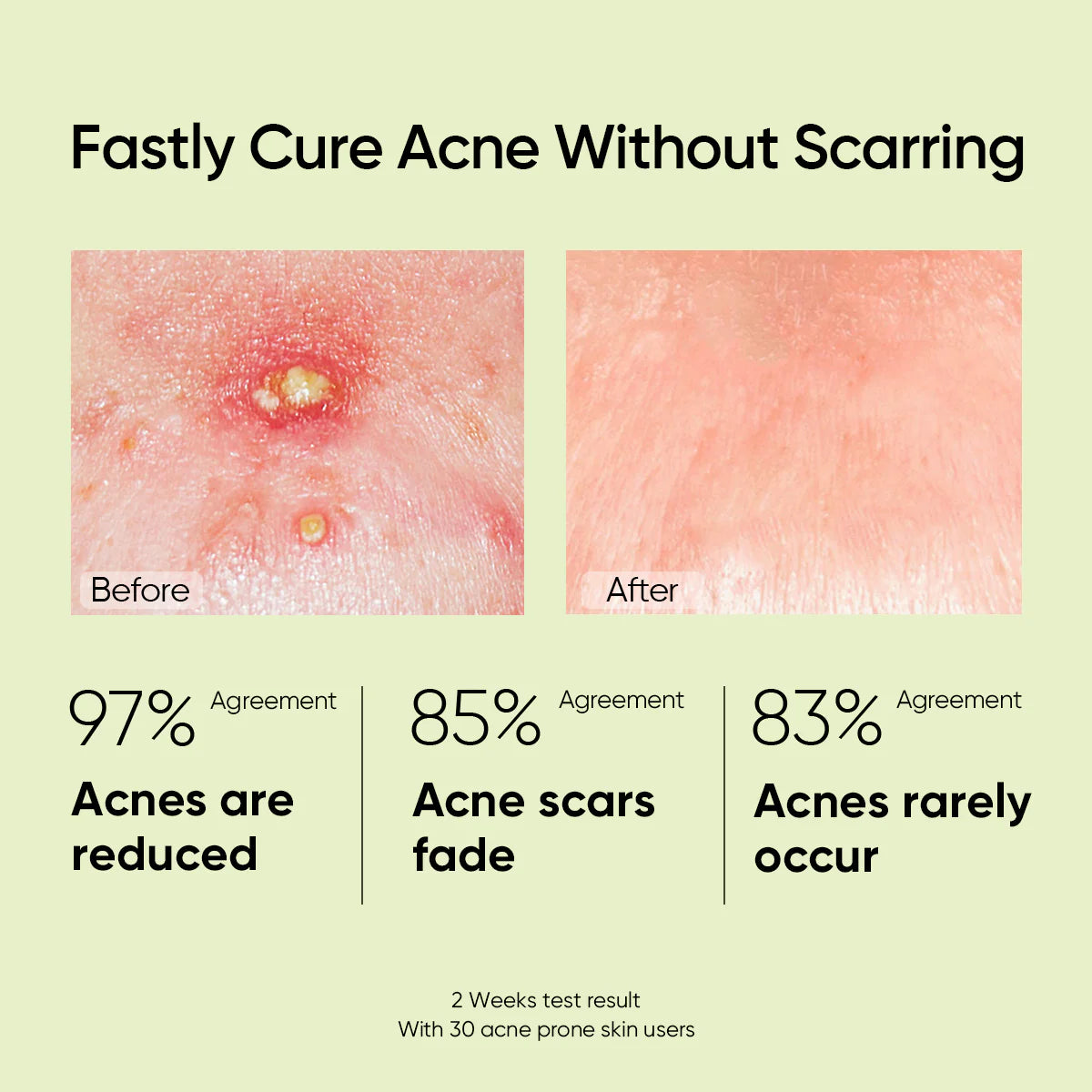 SKINTIFIC Salicylic Acid Acne Spot Gel