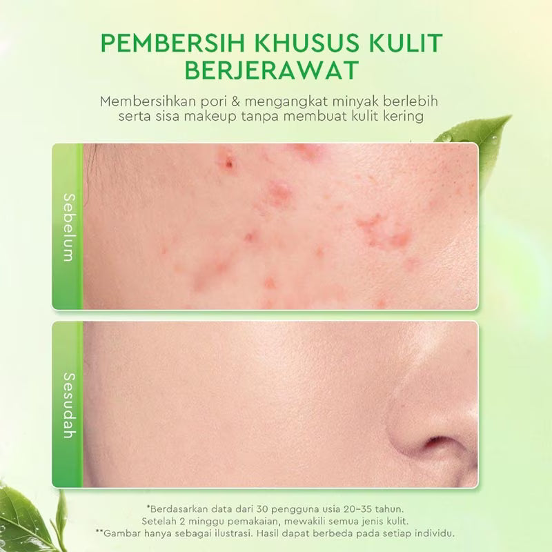 GLAD2GLOW Matcha Salicylic Acid Acne Cleanser